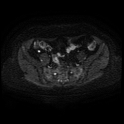 Adenoma malignum of cervix (Radiopaedia 66441-75705 Axial DWI 27).jpg