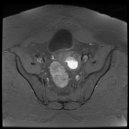 File:Adenomyosis within a didelphys uterus (Radiopaedia 70175-80215 Axial T1 fat sat 23).jpg