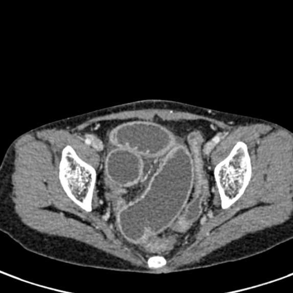 Adhesional small bowel obstruction (Radiopaedia 48397-53305 Axial C+ portal venous phase 82).jpg
