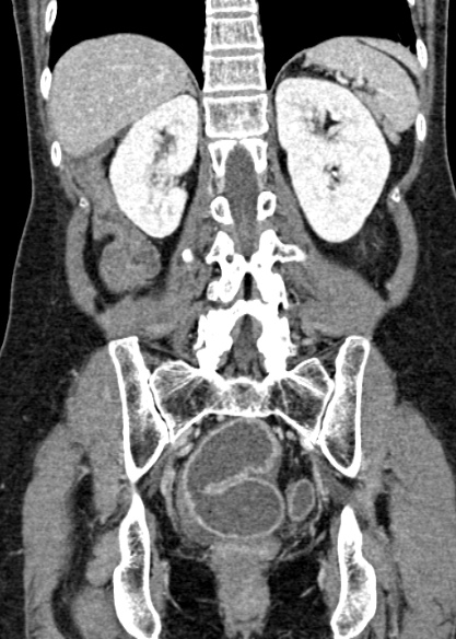Adhesional small bowel obstruction (Radiopaedia 48397-53305 Coronal C+ portal venous phase 252).jpg