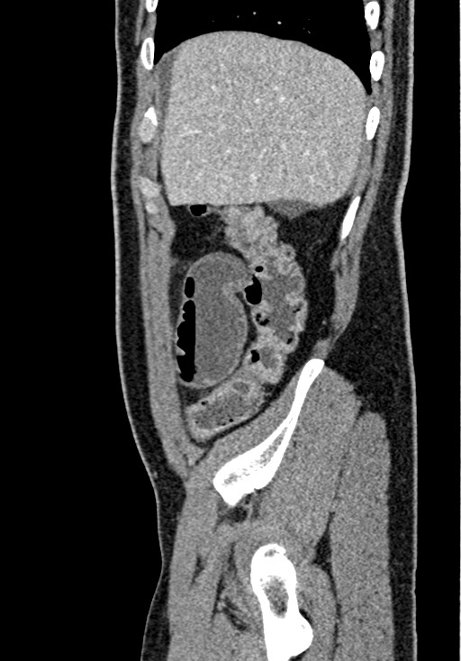 Adhesional small bowel obstruction (Radiopaedia 58900-66131 Sagittal C+ portal venous phase 44).jpg