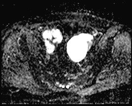 File:Adnexal multilocular cyst (O-RADS US 3. O-RADS MRI 3) (Radiopaedia 87426-103754 Axial 161).jpeg