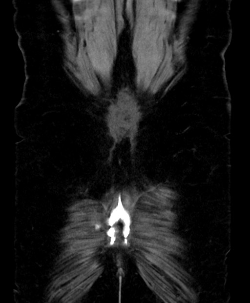 Adrenal cortical carcinoma (Radiopaedia 64017-72769 Coronal C+ delayed 57).jpg