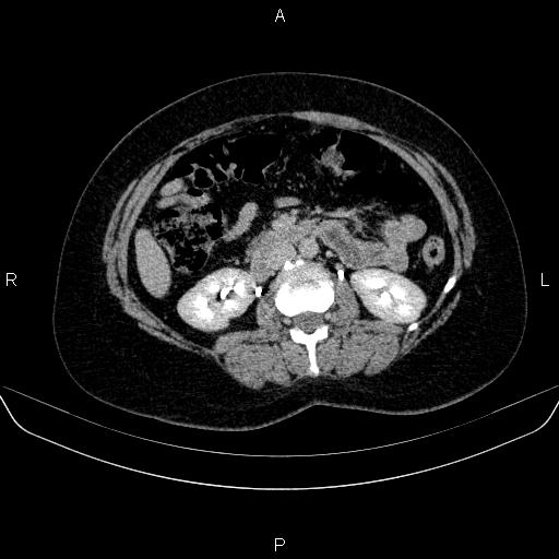 Adrenal cortical carcinoma (Radiopaedia 84882-100379 Axial C+ delayed 41).jpg