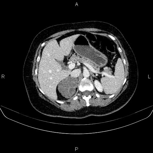Adrenal cortical carcinoma (Radiopaedia 84882-100379 Axial C+ portal venous phase 26).jpg