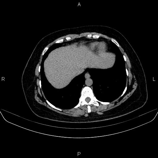File:Adrenal cortical carcinoma (Radiopaedia 84882-100379 Axial non-contrast 10).jpg