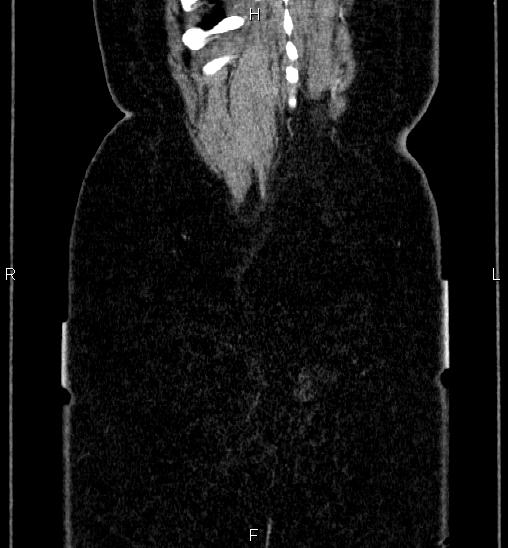 Adrenal cortical carcinoma (Radiopaedia 84882-100379 Coronal C+ portal venous phase 65).jpg