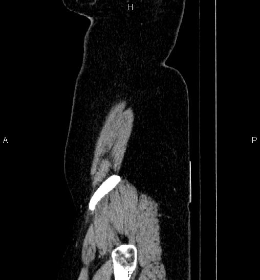 Adrenal cortical carcinoma (Radiopaedia 84882-100379 Sagittal C+ portal venous phase 2).jpg