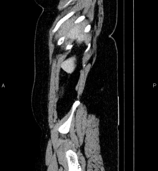 Adrenal cortical carcinoma (Radiopaedia 84882-100379 Sagittal C+ portal venous phase 9).jpg