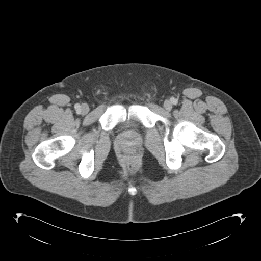 File:Adrenal cyst (Radiopaedia 45625-49776 Axial C+ portal venous phase 98).png