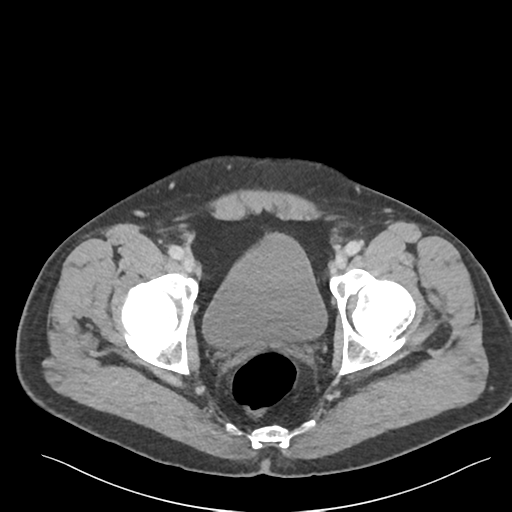 Adrenal cyst (Radiopaedia 45625-49777 Axial C+ portal venous phase 94).png