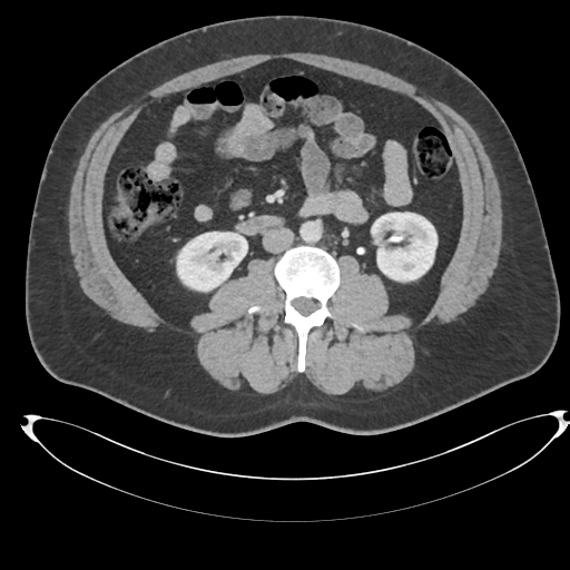 File:Adrenal cyst (Radiopaedia 45625-49778 AXIAL THICK 60 sec 51).png