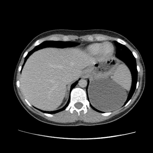 File:Adrenal cyst (Radiopaedia 64869-73813 Axial C+ portal venous phase 15).jpg