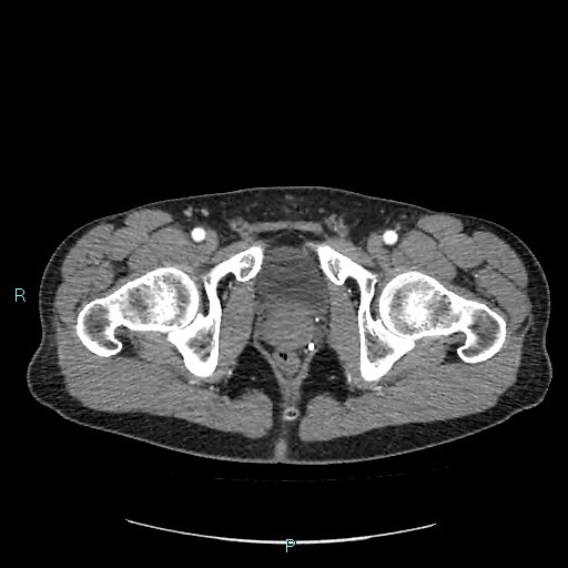 File:Adrenal cystic lymphangioma (Radiopaedia 83161-97534 Axial C+ arterial phase 98).jpg