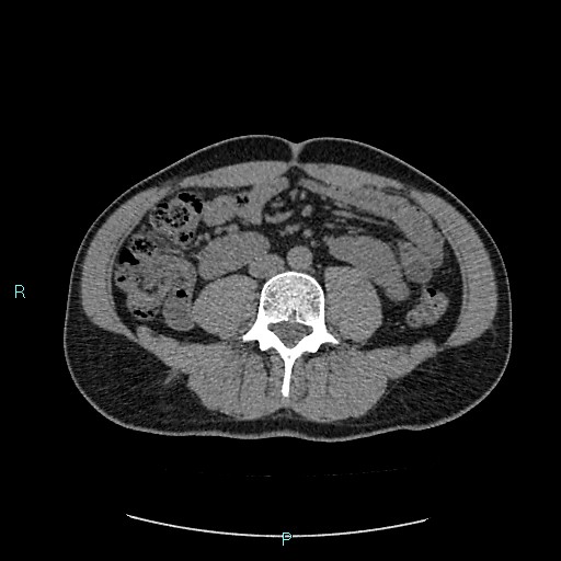 Adrenal cystic lymphangioma (Radiopaedia 83161-97534 Axial non-contrast 56).jpg