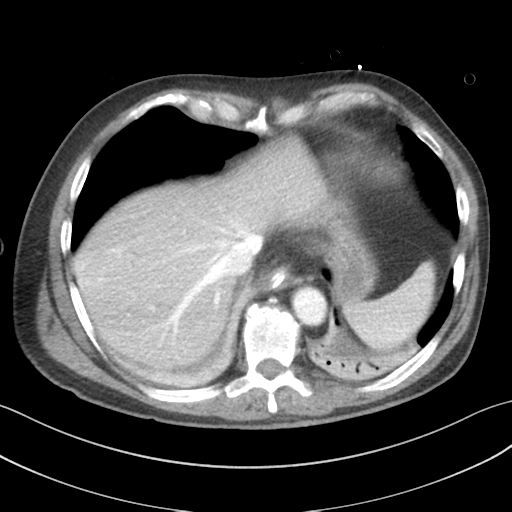 Adrenal hematoma (Radiopaedia 44334-47968 Axial C+ portal venous phase 9).png