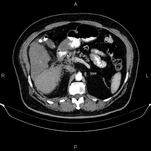 Adrenal hemorrhage (Radiopaedia 62622-70916 Axial C+ arterial phase 132).jpg