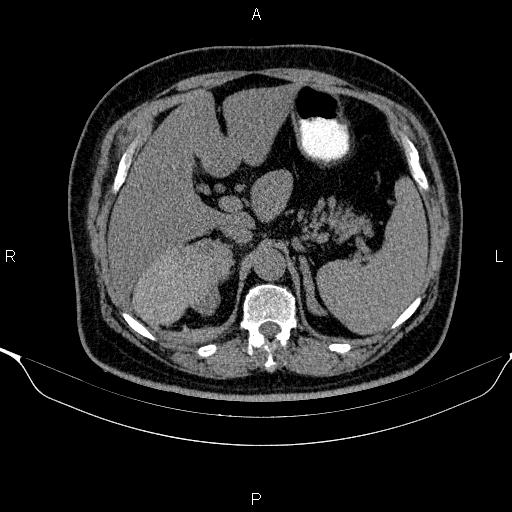 Adrenal hemorrhage (Radiopaedia 62622-70916 Axial non-contrast 49).jpg