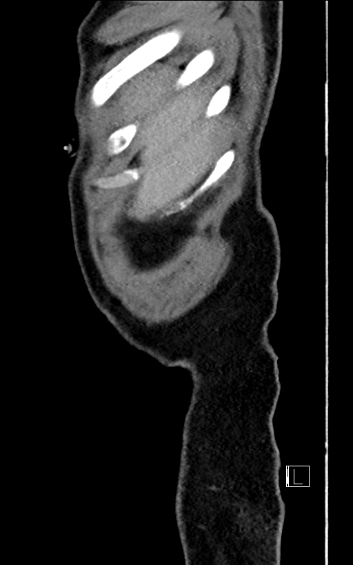 Adrenal lymphoma (Radiopaedia 73730-84529 Sagittal C+ portal venous phase 5).jpg