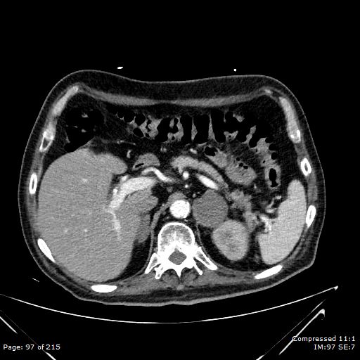 Adrenal metastasis (Radiopaedia 78425-91079 Axial C+ arterial phase 27).jpg
