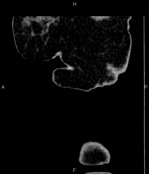 File:Adrenal myelolipoma (Radiopaedia 82742-96986 Sagittal renal cortical phase 2).jpg