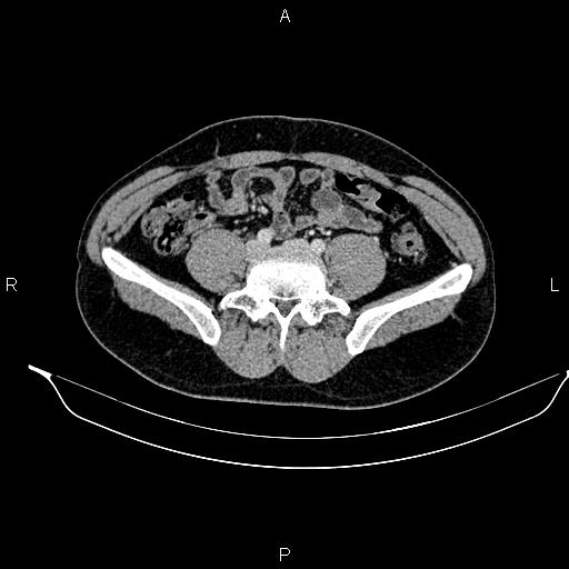 Adrenal myelolipoma (Radiopaedia 87794-104246 Axial renal cortical phase 72).jpg