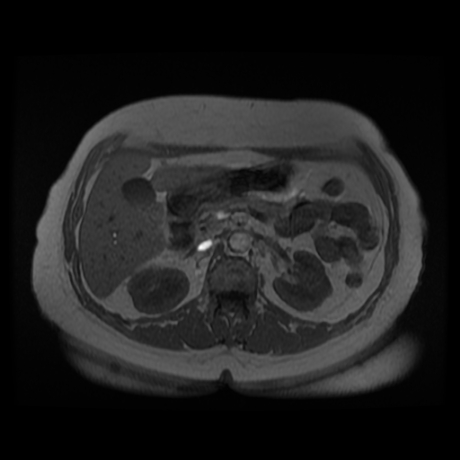 File:Adrenal myelolipoma - MRI (Radiopaedia 83249-97646 Axial T1-in phase 13).jpg