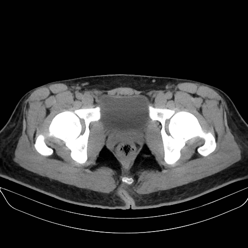 Adrenal myelolipoma - bilateral (Radiopaedia 74805-85810 Axial non-contrast 81).jpg