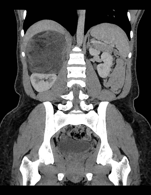 Adrenal myelolipoma - bilateral (Radiopaedia 74805-85810 Coronal C+ portal venous phase 124).jpg
