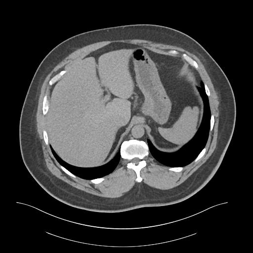 File:Adrenal vein sampling and adrenal nodular hyperplasia - Conn syndrome (Radiopaedia 30561-31337 Axial non-contrast 13).jpg