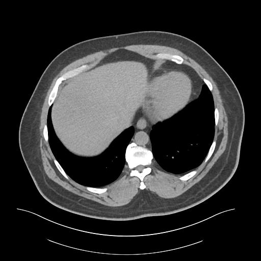 File:Adrenal vein sampling and adrenal nodular hyperplasia - Conn syndrome (Radiopaedia 30561-31337 Axial non-contrast 3).jpg