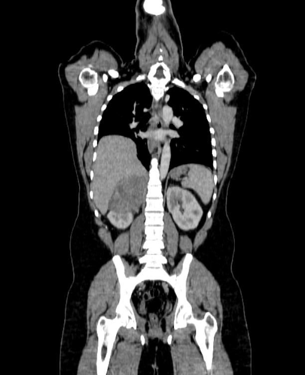 Adrenocortical carcinoma (Radiopaedia 80134-93438 Coronal C+ portal venous phase 110).jpg