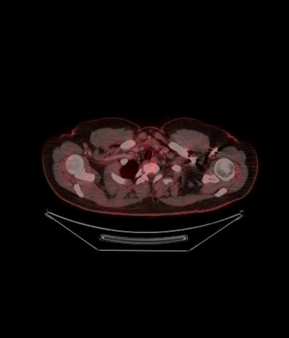 Adrenocortical carcinoma (Radiopaedia 80134-93440 ِAxial 86).jpg