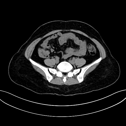 Adrenocortical carcinoma (Radiopaedia 87281-103569 Axial non-contrast 61).jpg
