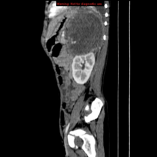 File:Adrenocortical carcinoma (Radiopaedia 9449-10131 Sagittal C+ portal venous phase 13).jpg