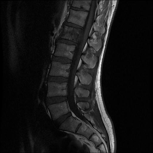 File:Aggressive vertebral hemangioma with pathological fracture (Radiopaedia 69528-79411 Sagittal T1 5).jpg