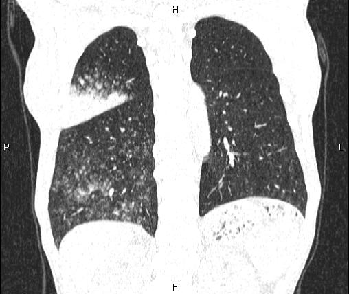 Air bronchogram in pneumonia (Radiopaedia 85719-101512 Coronal lung window 44).jpg