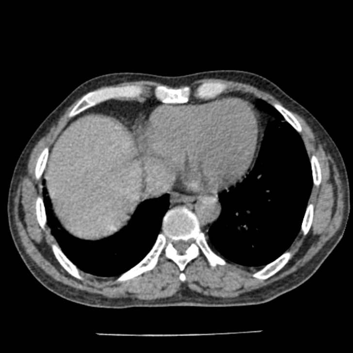 Airway foreign body in adult (Radiopaedia 85907-101779 Axial liver window 137).jpg
