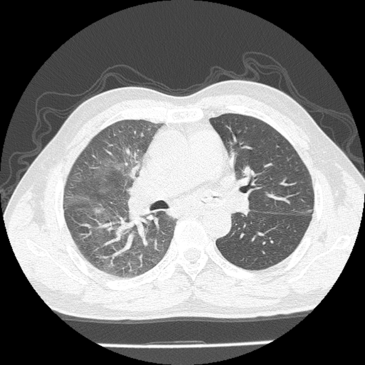 Airway foreign body in adult (Radiopaedia 85907-101779 Axial lung window 70).jpg