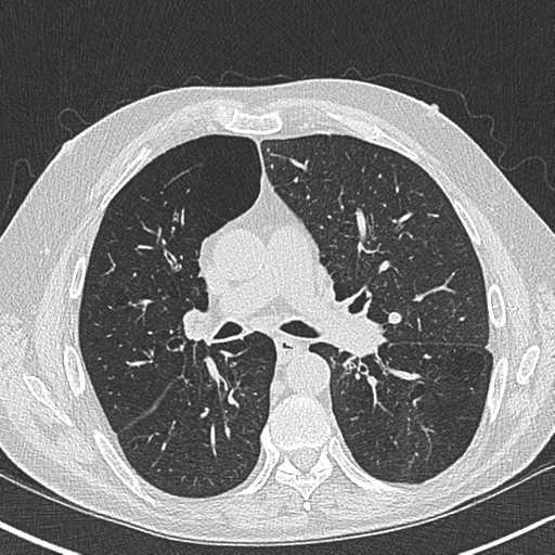Allergic bronchopulmonary aspergillosis (Radiopaedia 44760-48571 Axial lung window 30).png