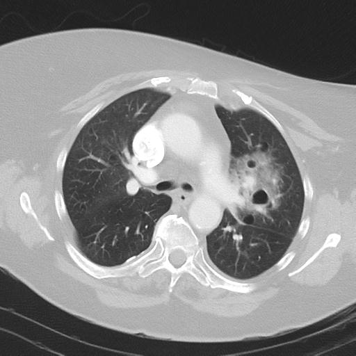 Alveolar hemorrhage and possible lymphocytic interstitial pneumonitis in systemic lupus erythematosus (Radiopaedia 28582-28839 Axial lung window 19).jpg