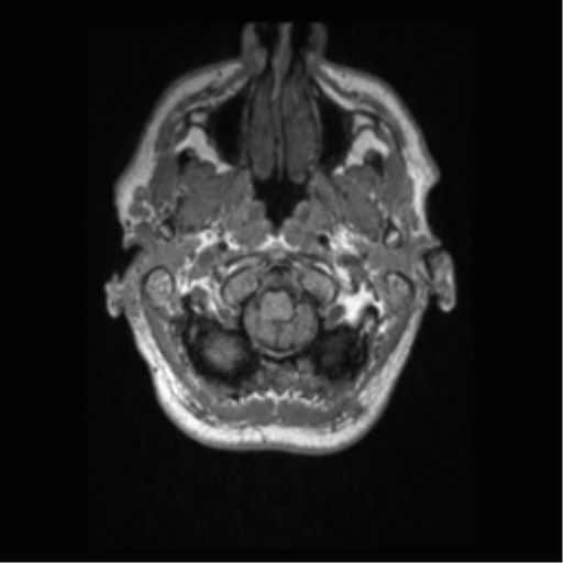 Alzheimer disease - probable (Radiopaedia 35334-36837 Axial T1 10).png