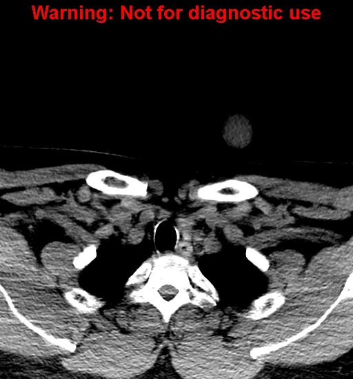 File:Ameloblastoma (Radiopaedia 33126-34164 A 45).jpg
