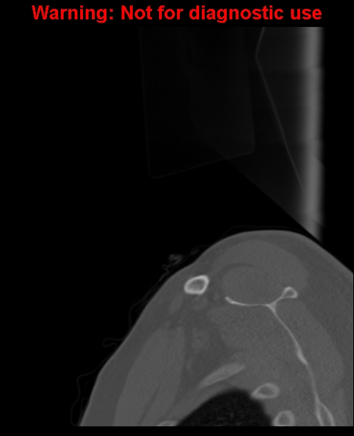 Ameloblastoma (Radiopaedia 33126-34164 Sagittal bone window 3).jpg
