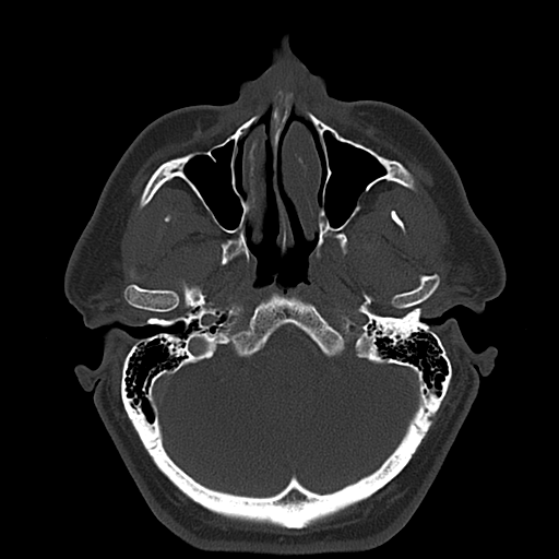 File:Ameloblastoma (Radiopaedia 38520-40623 Axial bone window 15).png