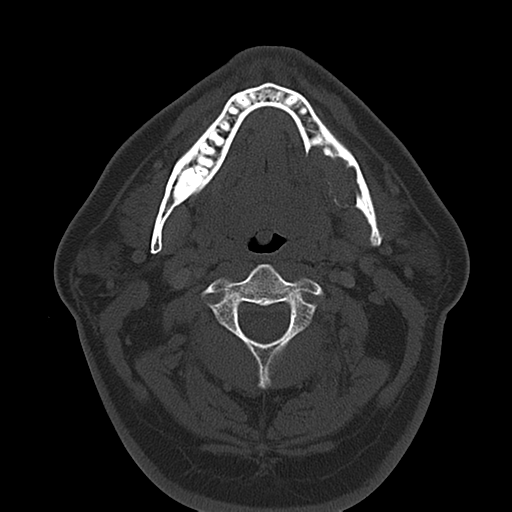 Ameloblastoma (Radiopaedia 38520-40623 Axial bone window 32).png