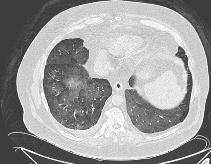File:Amiodarone lung (Radiopaedia 62514-70769 Axial lung window 68).jpg