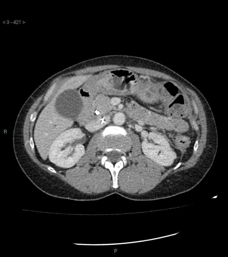 Ampulla of Vater metastasis (Radiopaedia 27820-28069 A 59).jpg