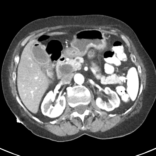 Ampullary adenocarcinoma (Radiopaedia 34013-35237 B 32).png