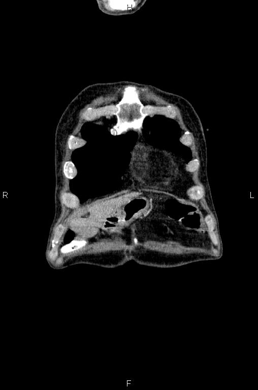 Ampullary adenocarcinoma (Radiopaedia 86093-102033 D 2).jpg